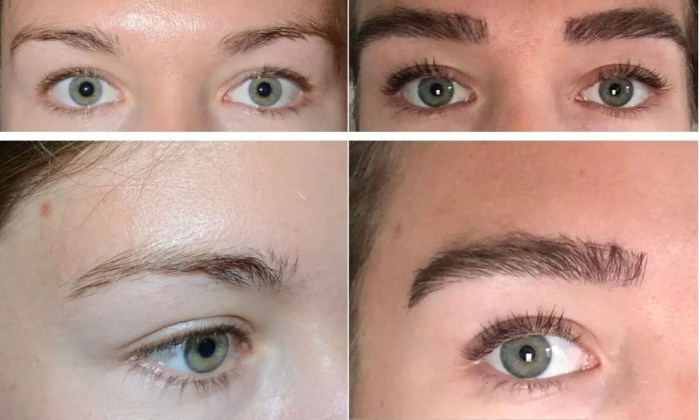Hair transplantation after implants natural look do consider things implantation what potential scarring Hair transplantation after implants natural look do consider things implantation what potential scarring